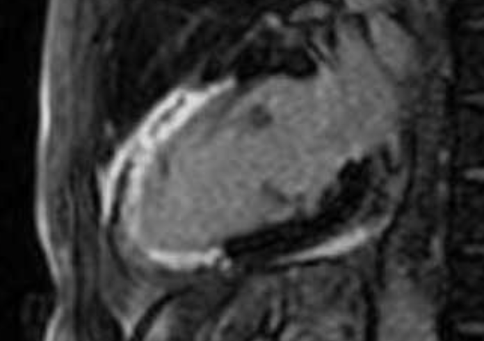 Revascularización percutánea en disfunción ventricular severa. REVIVED ...